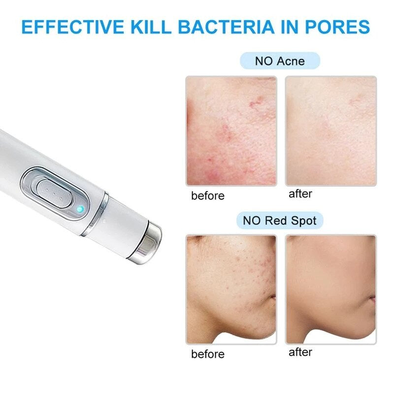 Laser Ultrasonic Skin Tightening Machine - Image 2