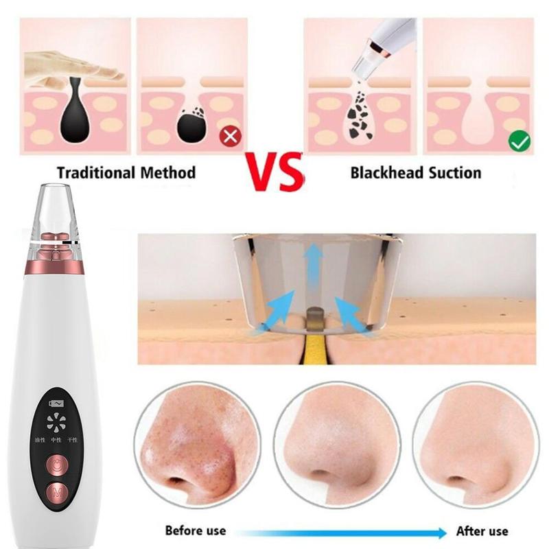 Pure Skin Rechargeable Blackhead Remover Machine