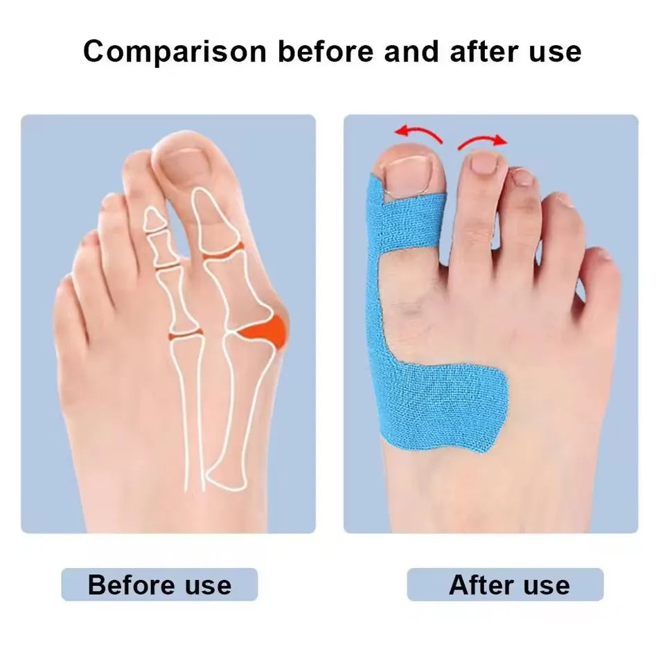 Bunion Relief Toe Alignment Correction Stickers - Image 4