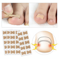 Toe Align Ingrown Nail Corrector Stickers - Image 1