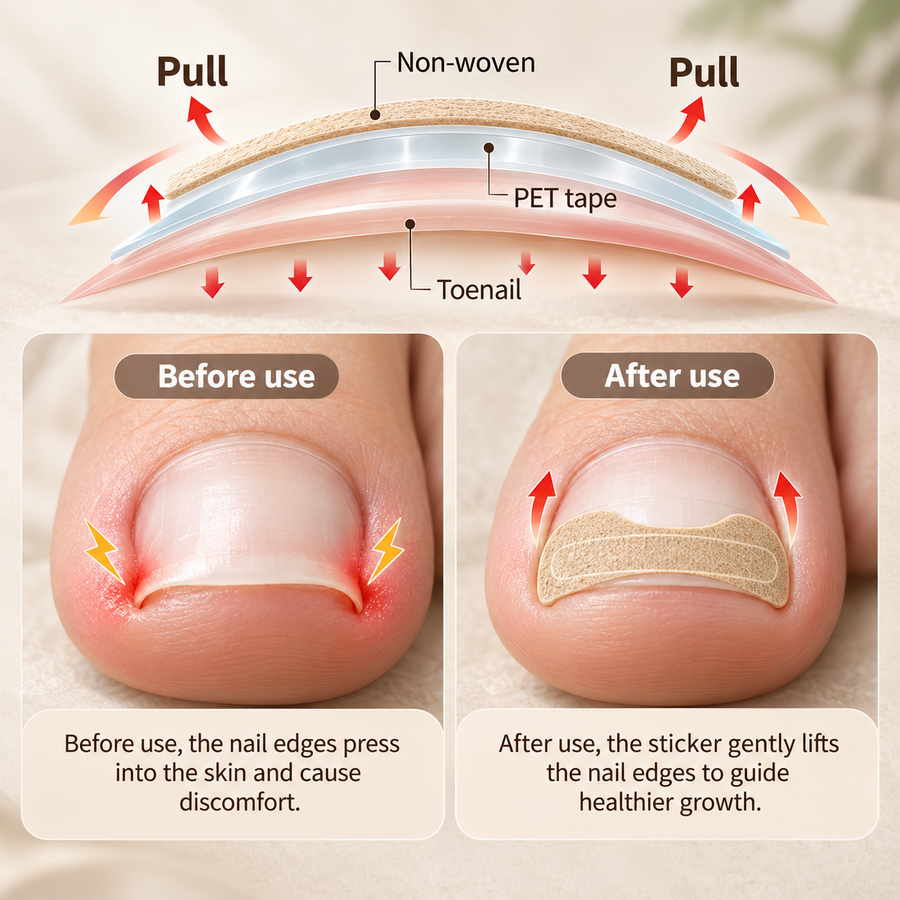 Autocollants Correcteurs d'Ongles Incarnés Toe Align